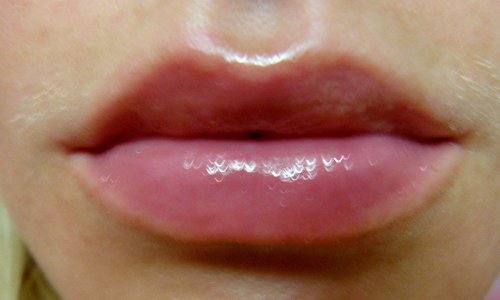 Метод увеличения губ гиалуроновой кислотой
