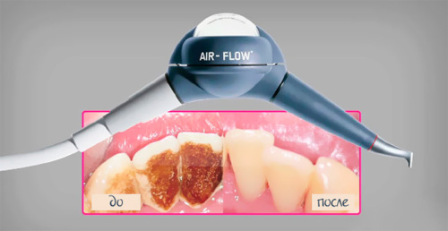 Чистка зубов системой Air Flow